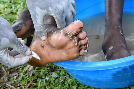 Jigger Treatment & Health Outreach